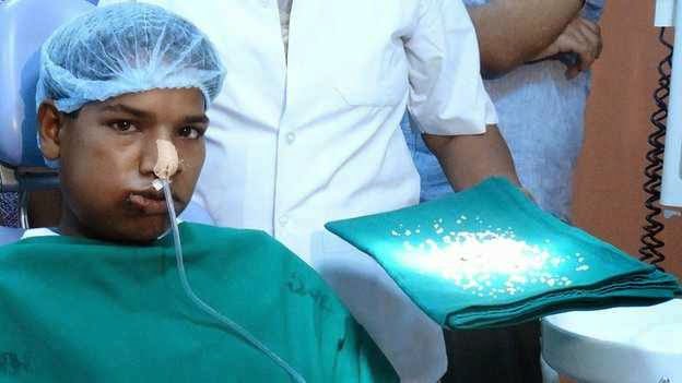 Doctors in India have extracted 232 teeth from the mouth of a 17 year old. The surgery lasted for seven hours. Ashik Gavai was brought in with a swelling in his right jaw, Dr Sunanda Dhiwa