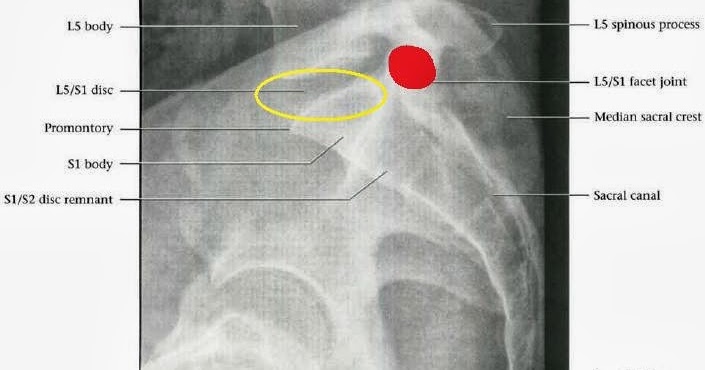 ABC Radiology Blog: Lumbarization & sacralization