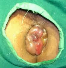 wasir salep obat wasir