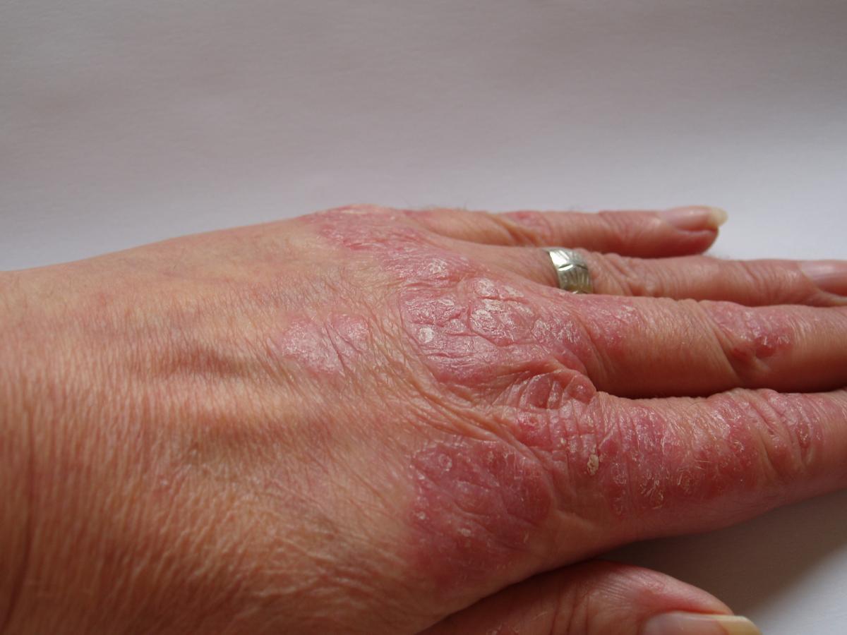 La psoriasis el tratamiento la carreta