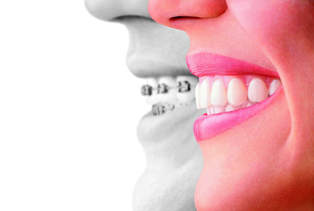 braces vs invisalign aligners #ad #invstraighttalk