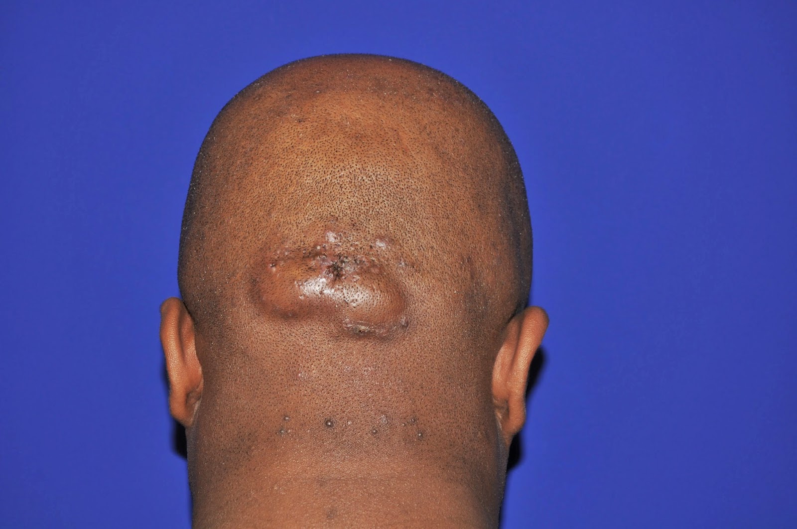Acne Keloidalis Scar Treatment at Ricky Perry blog
