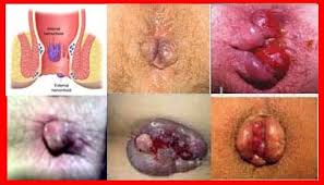 WASIR obat wasir parah / akut