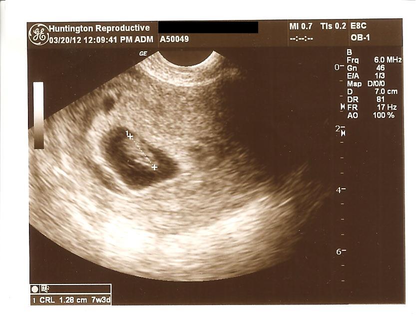 normal heartbeat for 9 week fetus
