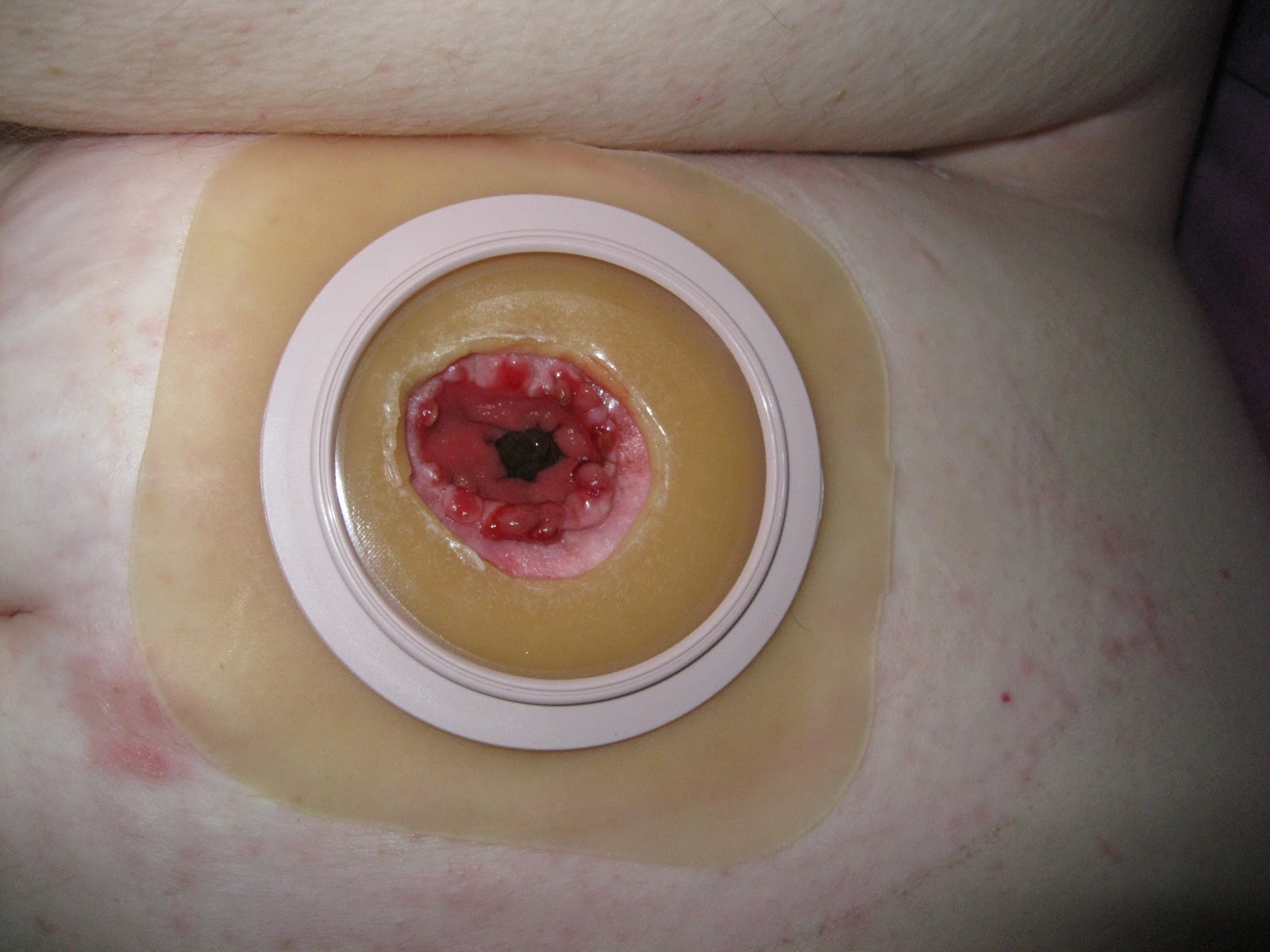 Wafer and putty applied to stoma. 