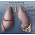 Mesothelioma definition, types, manifestations, prognosis, prevention, DD, treatment Mesothelioma definition, types, manifestations, prognosis, prevention, DD, treatment