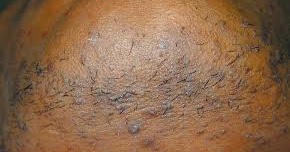 ingrown hair rid skin shaving getting problem there care