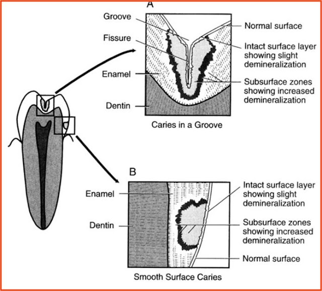 Dentistry lectures for MFDS/MJDF/NBDE/ORE A Lecture Note On Histopathology Of Dental Caries