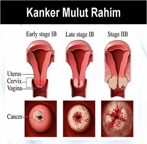 Image Herbal Untuk Kanker Serviks