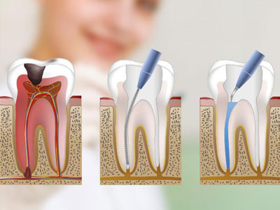 Endodoncias Endodoncias