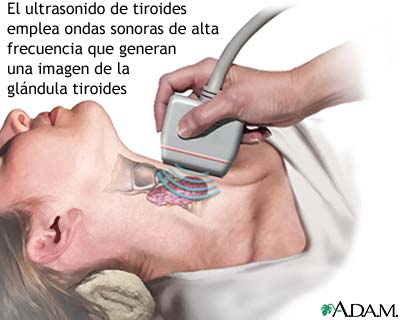 Ultrasonido Tiroideo