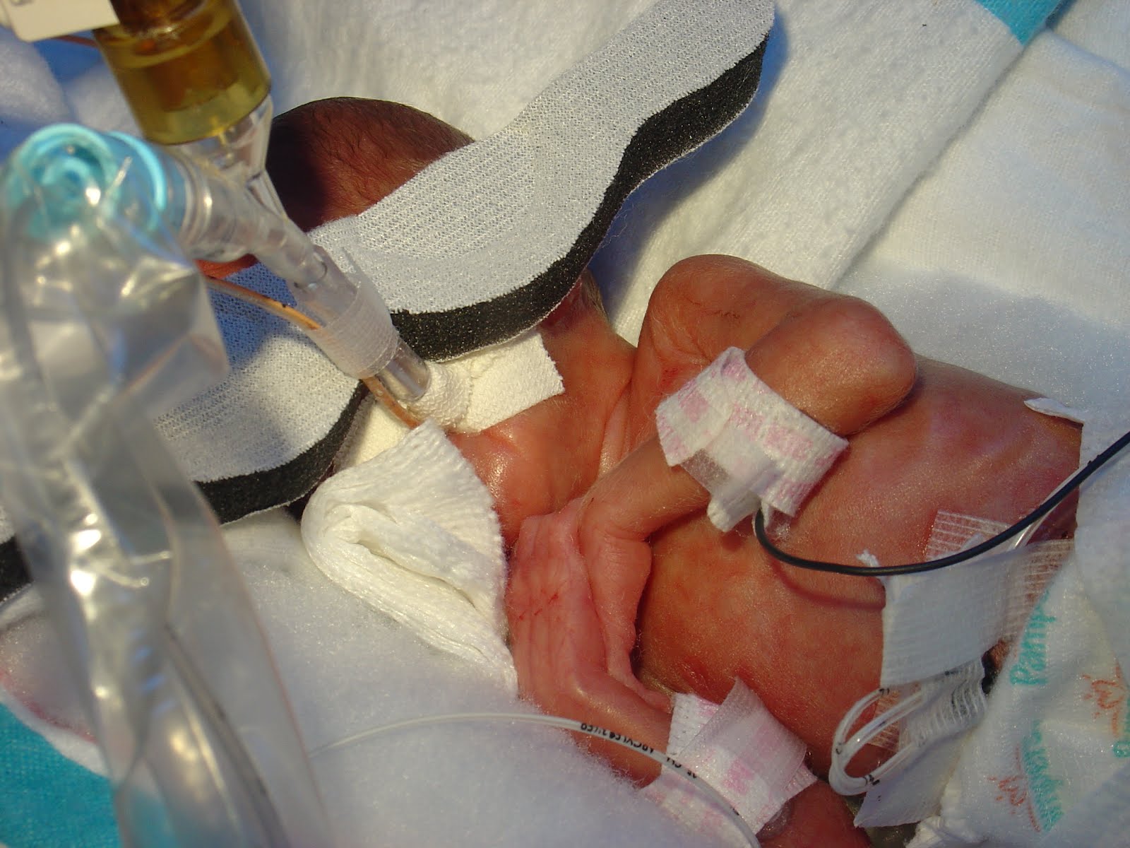 Micro Preemie Twins The Story of Holland & Eden 24 weeks and 3 days