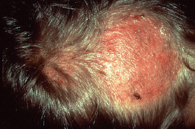 Alopecia caused by steroids