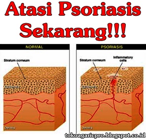 Obat Psoriasis Obat Psoriasis