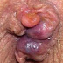 Obat Ambeien Hemoroid thumbnail