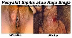 Penyakit Sipilis
