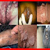 Basmi Virus HPV Kutil Kelamin dengan Antivirus Herbal thumbnail
