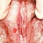 obat sipilis obat sipilis