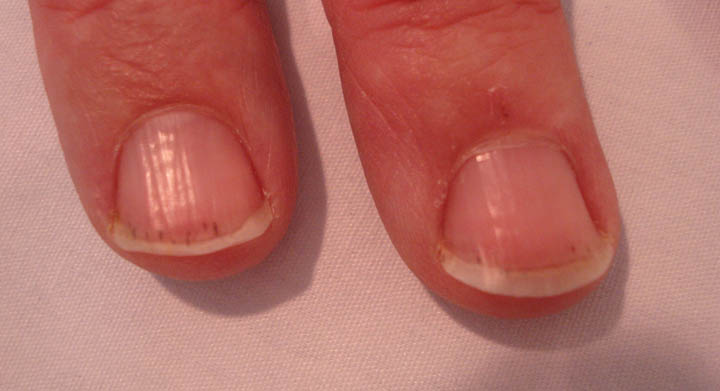 Virtual Grand Rounds In Dermatology 2 0 Splinter Hemorrhages Splinter Hemorrhages