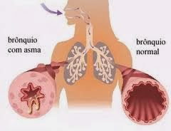 Ramuan Obat Penyembuh Asma Ramuan Obat Penyembuh Asma