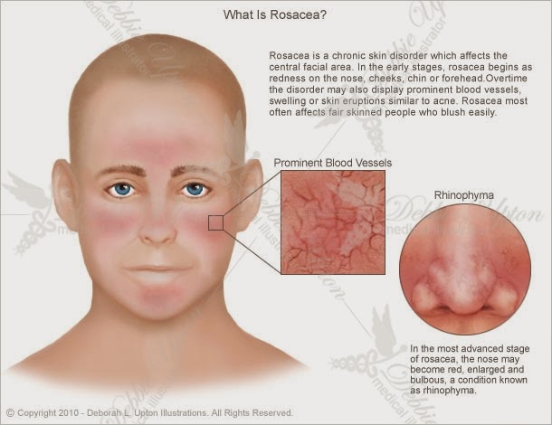 help for rosacea oily