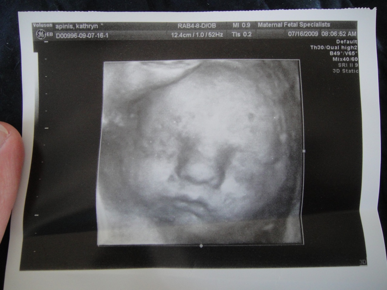 Samuel's Heart 36 weeks and Some Ultrasound Pictures