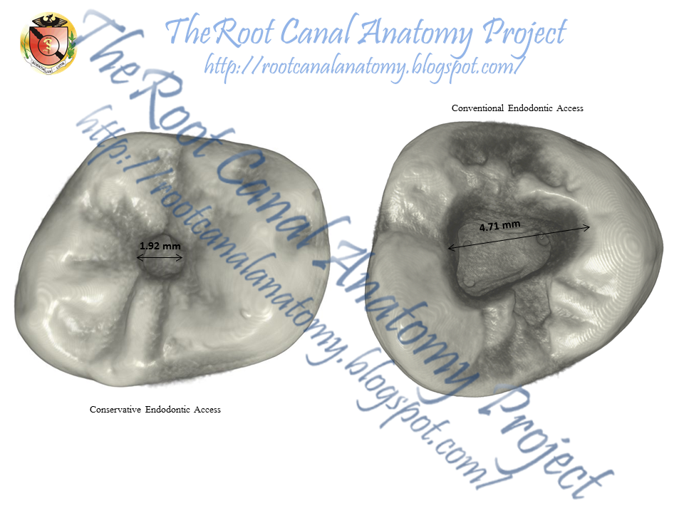 The Root Canal Anatomy Project: Conservative Endodontic Access