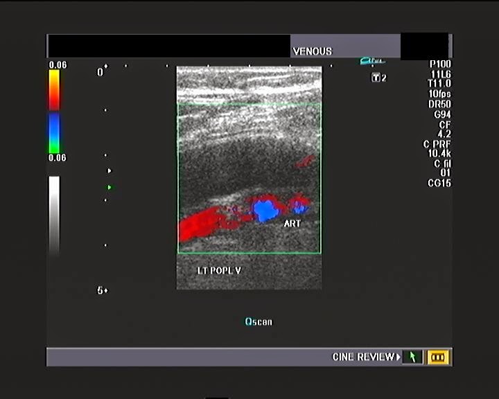 Ultrasound imaging A patient of calf and leg pain venous Doppler study