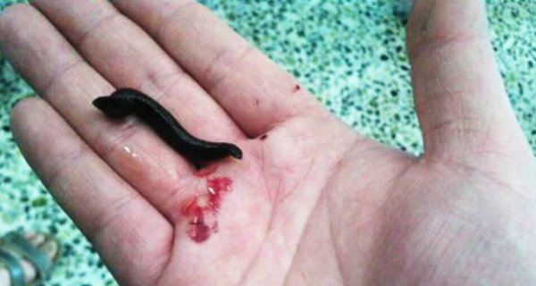 Doctors Find Yeugh In Boys Throat…“I Won’t Be Drinking Water From A Bucket Again!” He Said