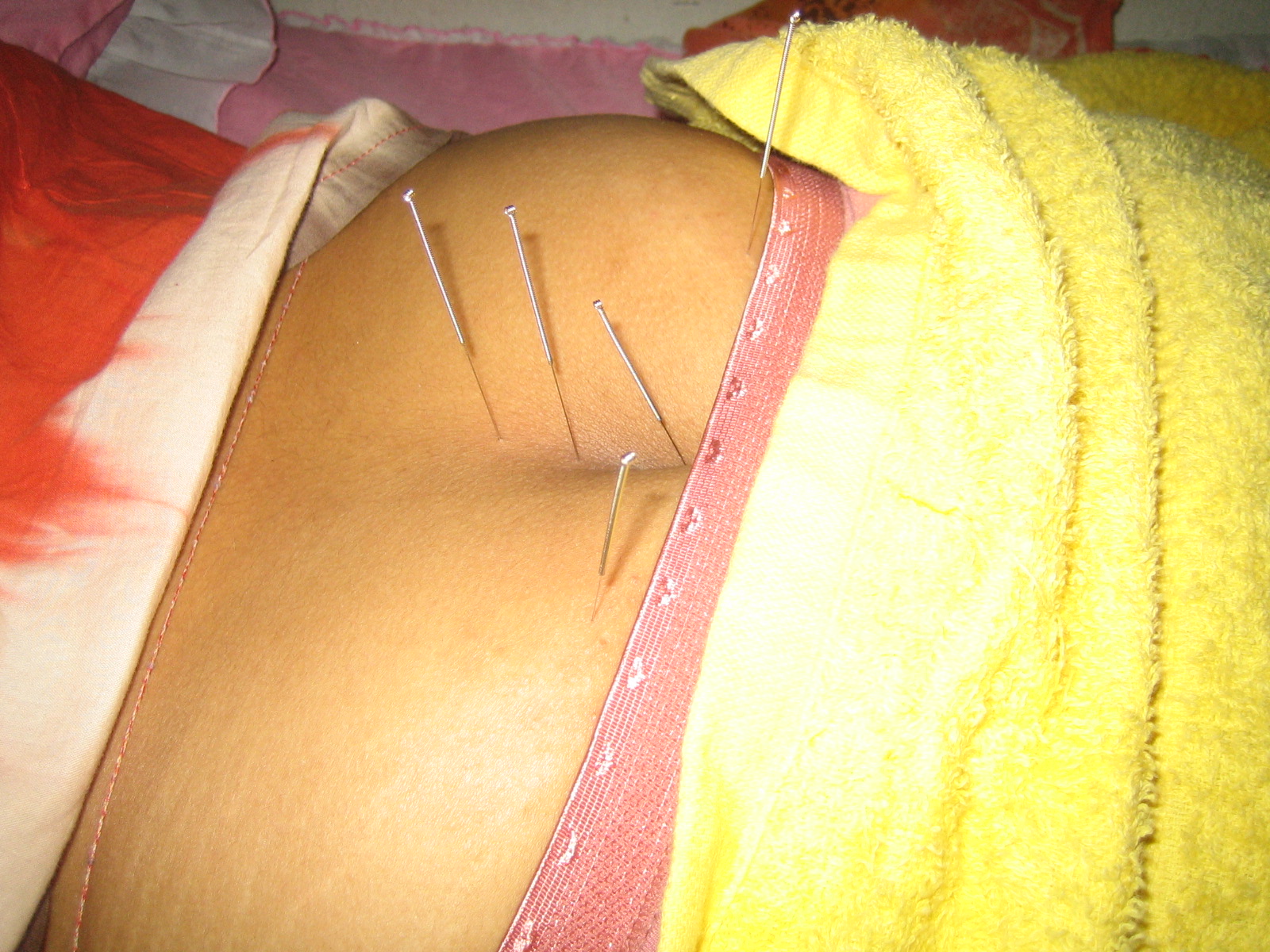 How Come Acupuncture Brings Perfect Recent Results For All'