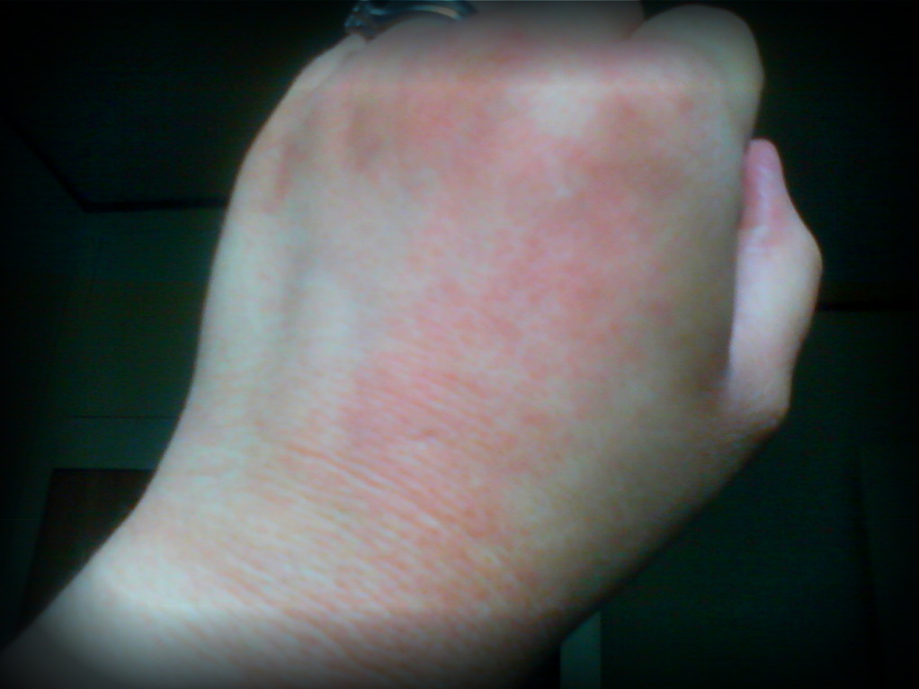 Ocd Hands