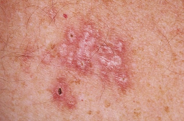Get All You Need to Know about Male Genital Herpes