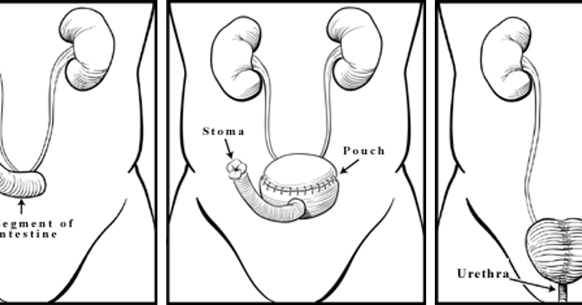 Brady Urology at Johns Hopkins Hospital Quality of Life after Surgery