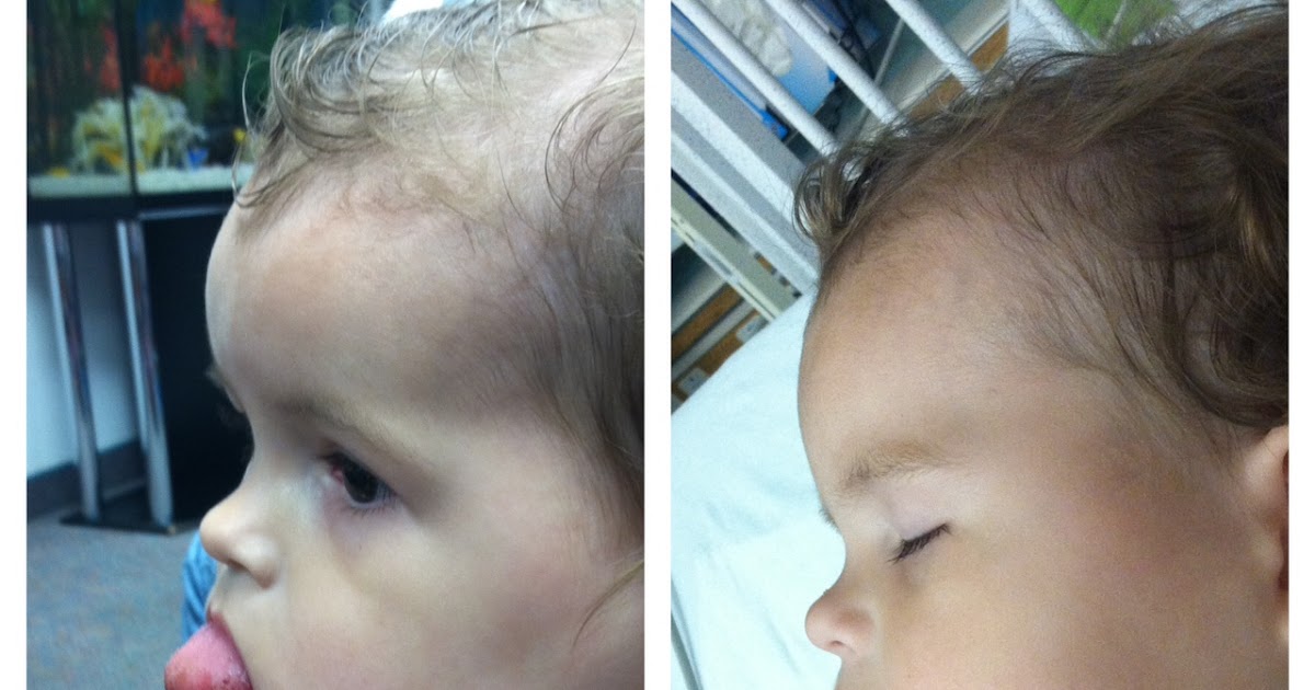 Trach Ties A tale of two tongues the tongue reduction