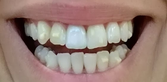invisalign attachments