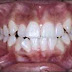 Dentes anteriores apinhados (encavalados): Existe outra opção de tratamento além do ortodôntico?