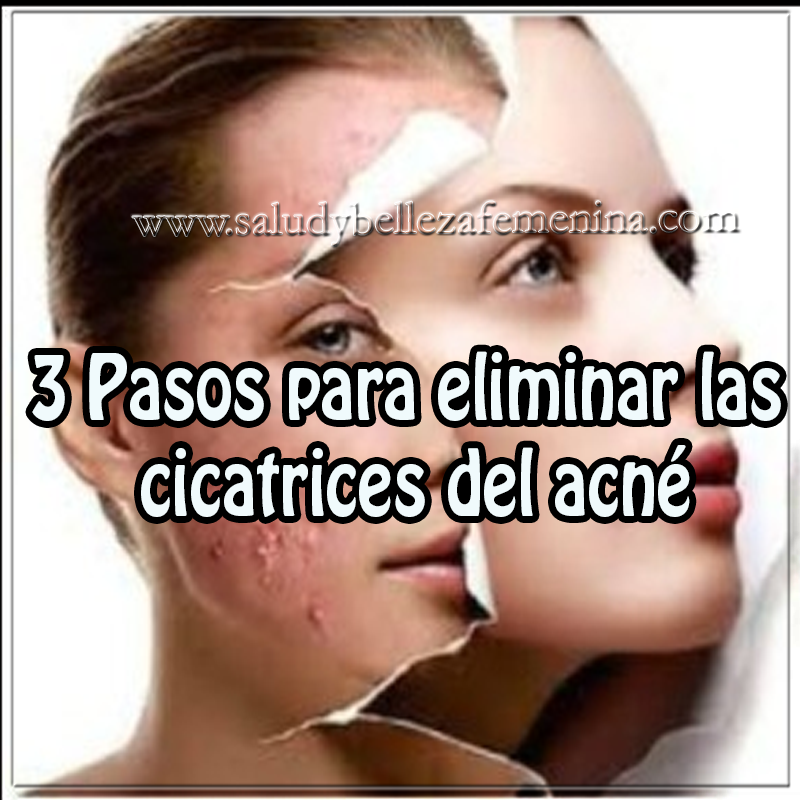 3 Pasos para eliminar las cicatrices del acné Mascaras faciales, recetas para eliminar cicatrices del acné , belleza,