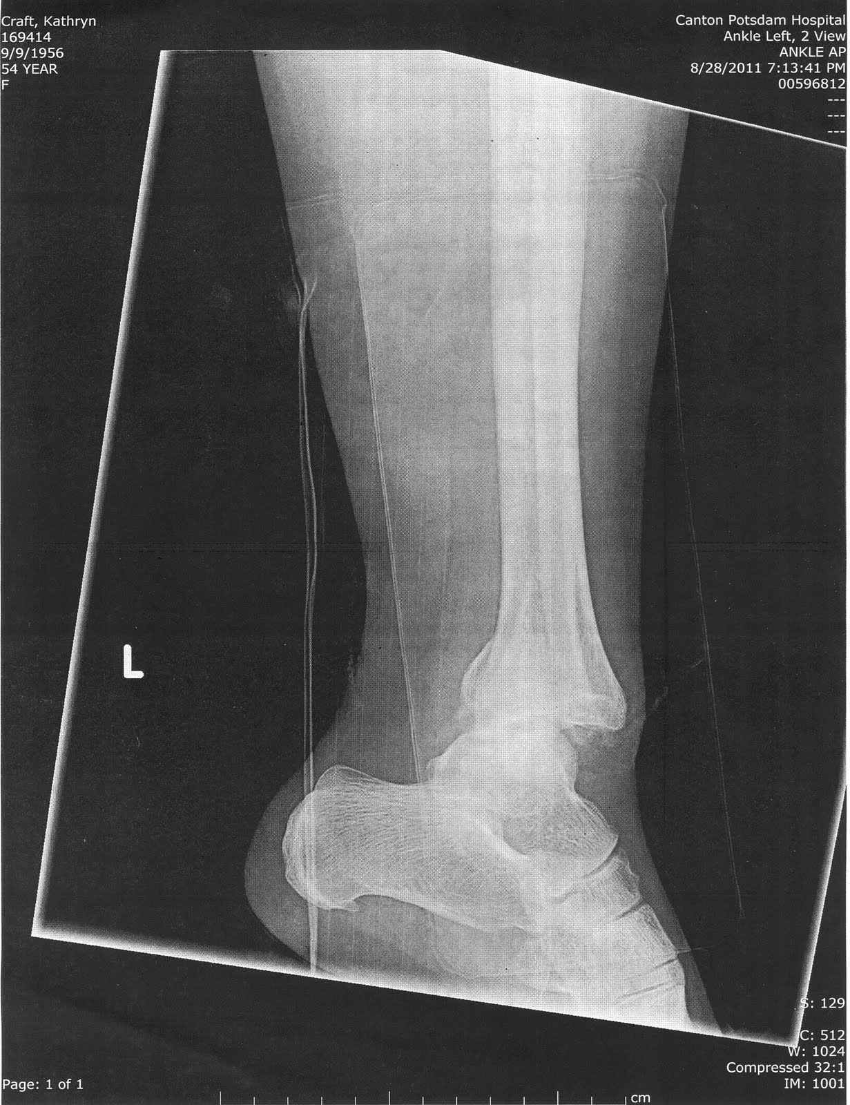 Medial malleolus fracture recovery time image