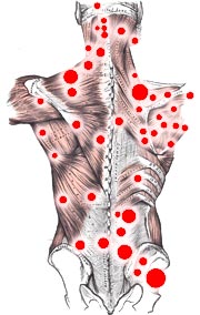 Fibro Trigger Points Chart Images