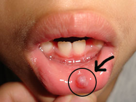 lip cancer symptoms