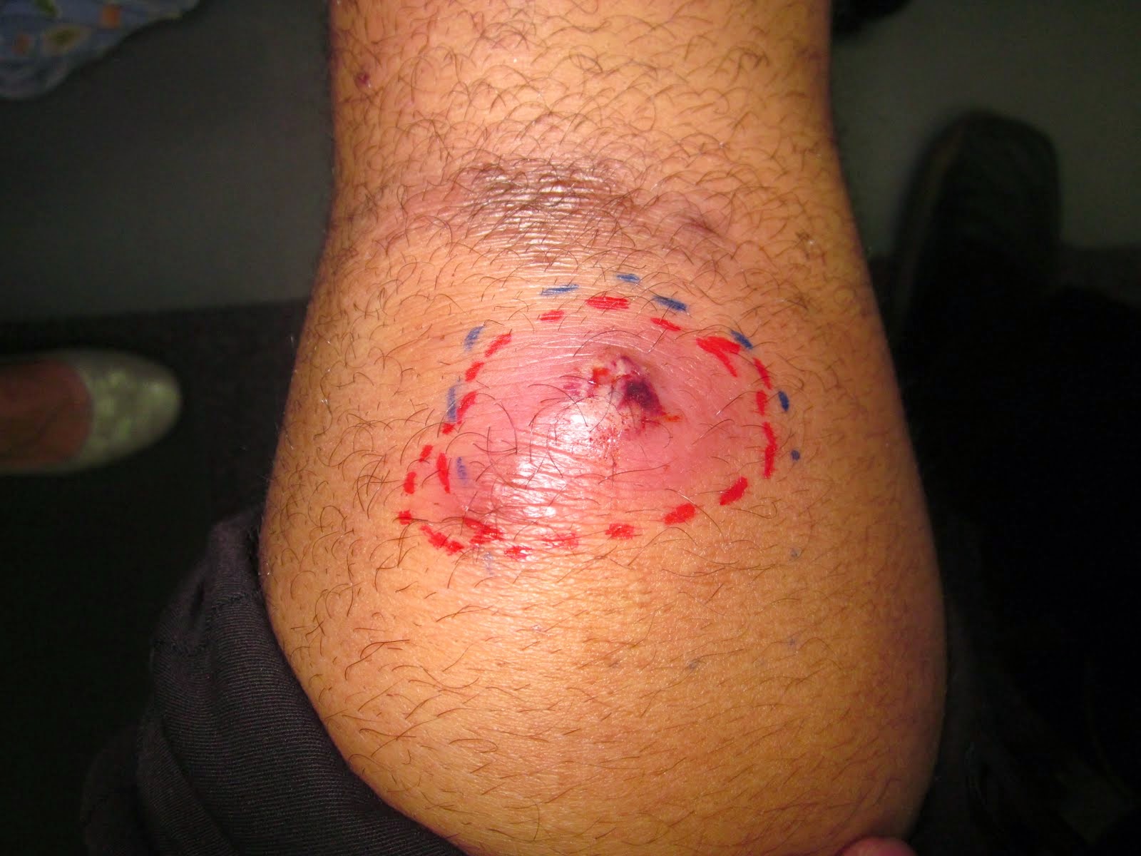 A cyst in my knee from too much praying on them lol