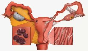 Cara Menyembuhkan Kista Endometriosis