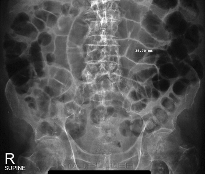 step ladder appearance small bowel DriverLayer Search Engine