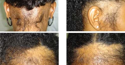 Après la lactation tombent les cheveux fortement que faire