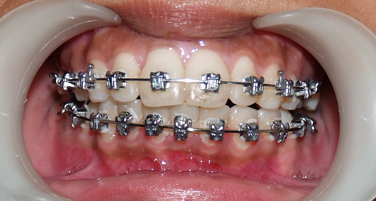 Invisible Braces In Bangalore Quick, Accelerated Braces treatment with