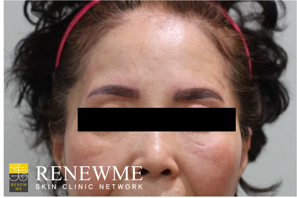renewme skin clinic eyebrow tattoo removal at renewme renewme skin clinic eyebrow tattoo removal at renewme