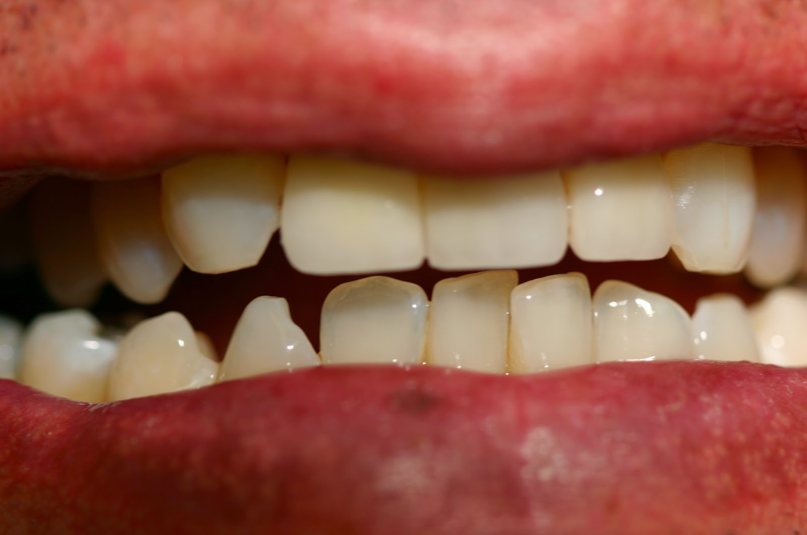 Amazing (Uneven) Front Teeth Robert G. Tupac, D.D.S., F.A.C.P