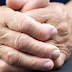 Artrite reumatoide e a Fisioterapia