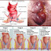 Obat Wasir Ambeien thumbnail