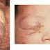 Obat Infeksi Gonorrhea Cara Mengatasi Kencing Nanah thumbnail
